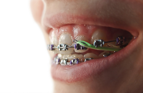 Braces Elastics (Rubber Bands) for Bite Correction and Alignment « Smile  Team Orthodontics