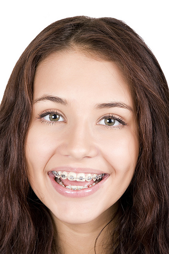 What Is A Poking Wire In Braces and Orthodontics? - ArchWired