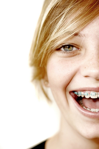 Besides Straight Teeth What Are The Benefits Of Braces